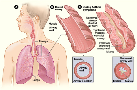 asthma_lung